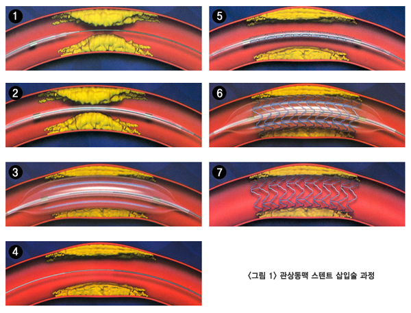 관상동맥 스텐트 삽입술 과정