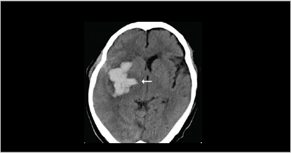 수술전 뇌출혈 환자의 뇌 ct 사진 이미지