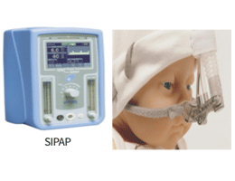 코를 통한 지속적 양압 환기법(Nasal CPAP)